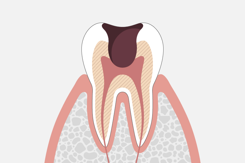 歯髄(神経)に達した虫歯