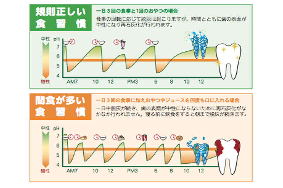 虫歯の原因について