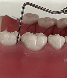 歯周基本検査2