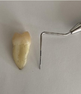 歯周基本検査1